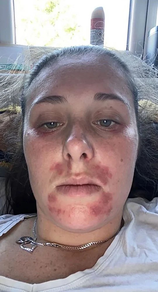 This girl, Charlotte Priest, took a photo after her vape dried up her skin severely making her eczema worse. 
